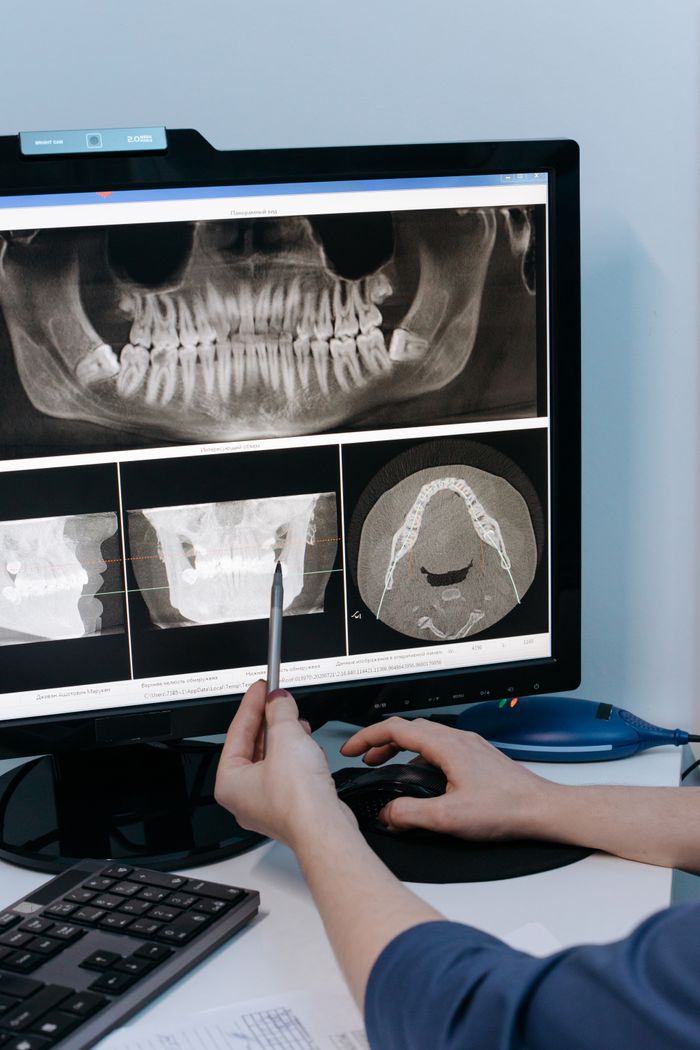 Close-up of a dental professional analyzing X-ray scans on a computer monitor.